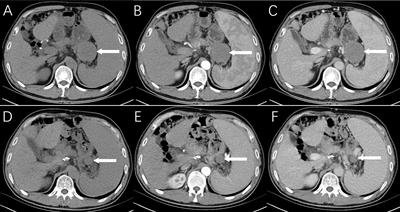 Reactive Nodular Fibrous Pseudotumor Mimicking Metastatic Tumor After Gastric Cancer Operation: A Case Report and Literature Review